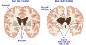 BỆNH HUNTINGTON: BỆNH DI TRUYỀN THOÁI HÓA THẦN KINH NGUY HIỂM CẦN NHẬN BIẾT SỚM