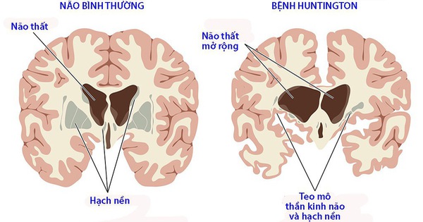 BỆNH HUNTINGTON: BỆNH DI TRUYỀN THOÁI HÓA THẦN KINH NGUY HIỂM CẦN NHẬN BIẾT SỚM