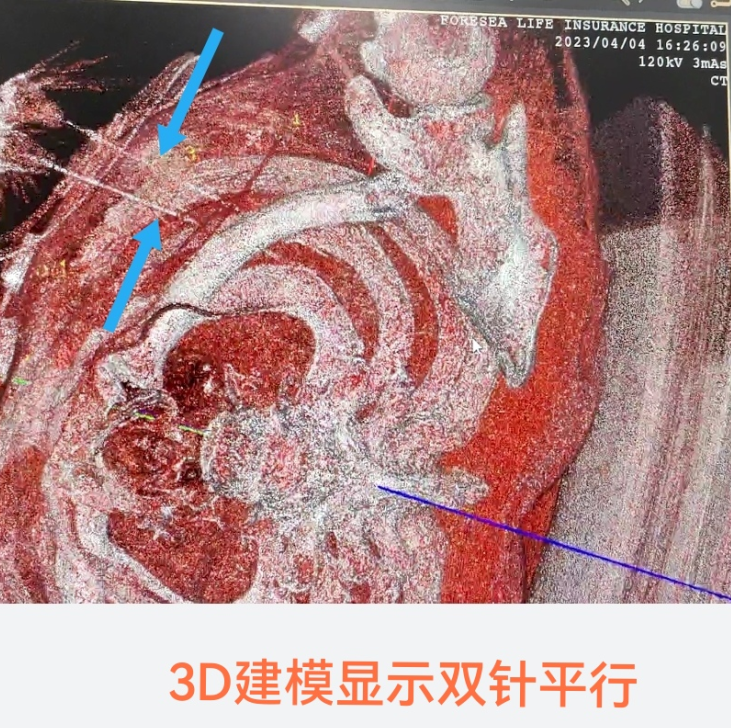 Ca điều trị triệt đốt khối u phổi qua da bằng một kim được dẫn đường bằng hệ thống định vị từ tính đầu tiên tại khu vực Quảng Châu