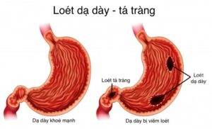 TỔNG QUAN BỆNH LÝ DẠ DÀY – TÁ TRÀNG: TRIỆU CHỨNG, NGUYÊN NHÂN, ĐIỀU TRỊ VÀ PHÒNG NGỪA