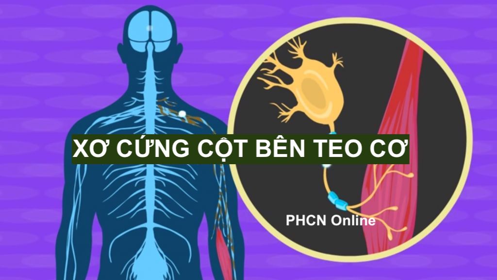 XƠ CỨNG CỘT BÊN TEO CƠ (ALS): BỆNH THOÁI HÓA THẦN KINH NGHIÊM TRỌNG CẦN ĐƯỢC PHÁT HIỆN SỚM