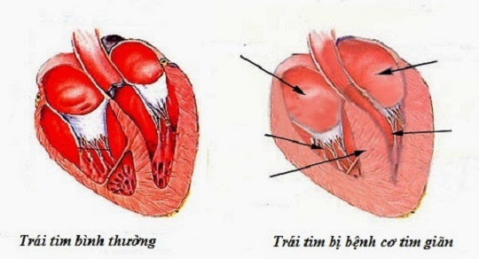 BỆNH CƠ TIM GIÃN (DILATED CARDIOMYOPATHY – DCM)