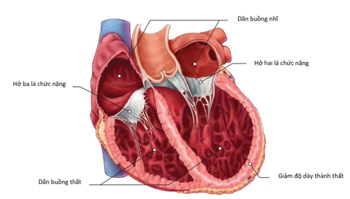 BỆNH CƠ TIM GIÃN (DILATED CARDIOMYOPATHY – DCM)