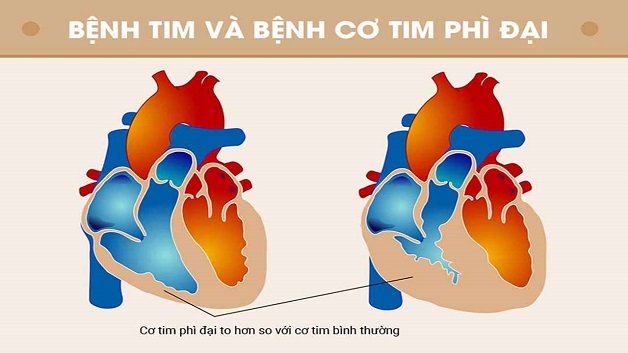 BỆNH CƠ TIM PHÌ ĐẠI (HCM): NGUYÊN NHÂN, TRIỆU CHỨNG, CHẨN ĐOÁN VÀ PHÁC ĐỒ ĐIỀU TRỊ HIỆN ĐẠI