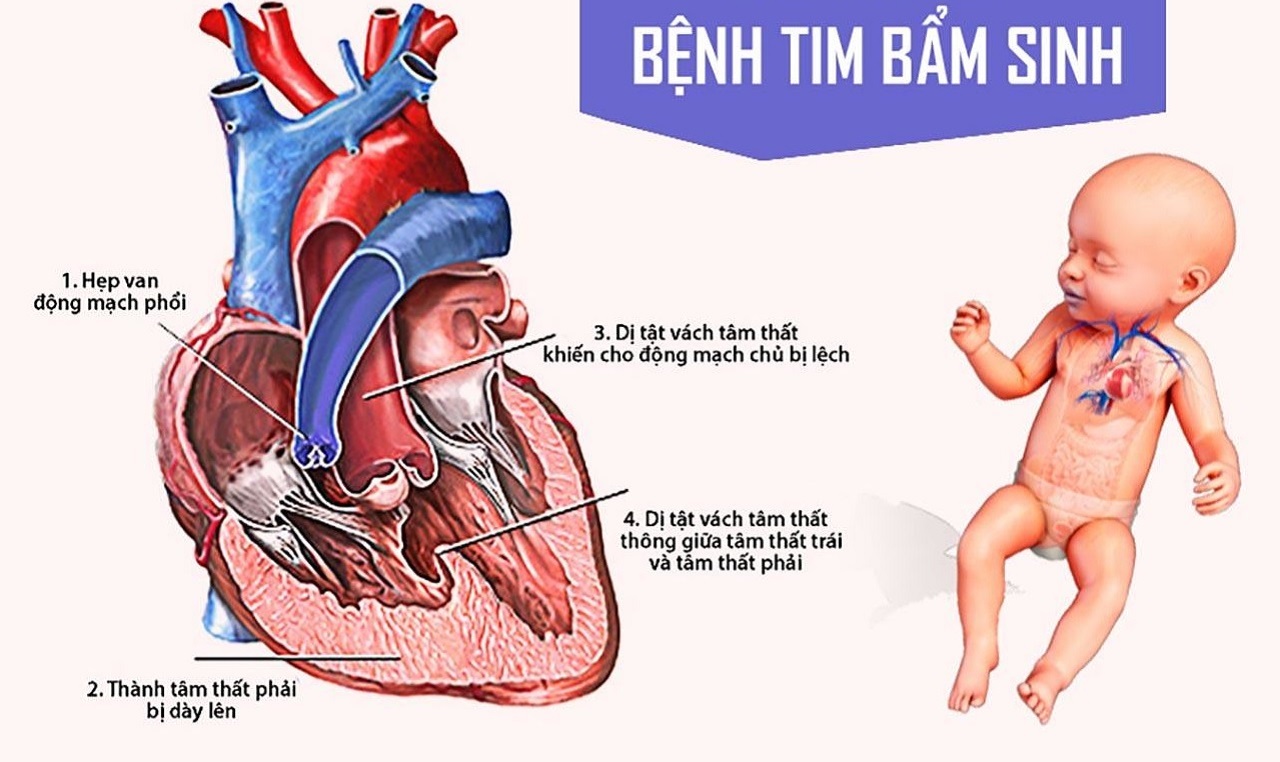 BỆNH TIM BẨM SINH PHỨC TẠP: TỔNG QUAN – CHẨN ĐOÁN – ĐIỀU TRỊ CHUYÊN SÂU