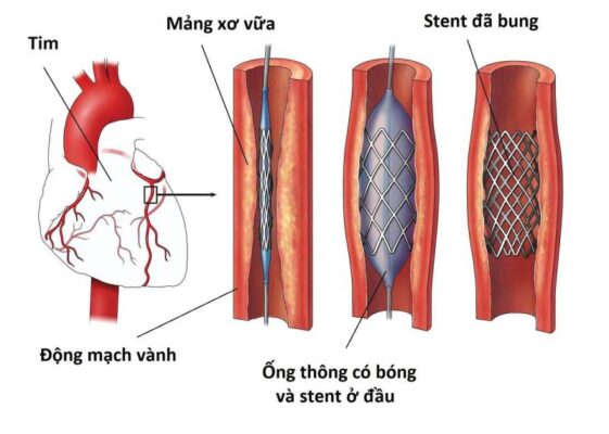 Đặt Stent Trong Bệnh Tim Mạch Là Gì? Quy Trình, Lợi Ích, Rủi Ro Và Lưu Ý Sau Can Thiệp