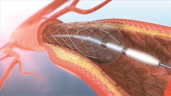 Đặt Stent Trong Bệnh Tim Mạch Là Gì? Quy Trình, Lợi Ích, Rủi Ro Và Lưu Ý Sau Can Thiệp