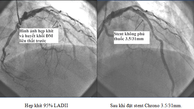 Đặt Stent Trong Bệnh Tim Mạch Là Gì? Quy Trình, Lợi Ích, Rủi Ro Và Lưu Ý Sau Can Thiệp