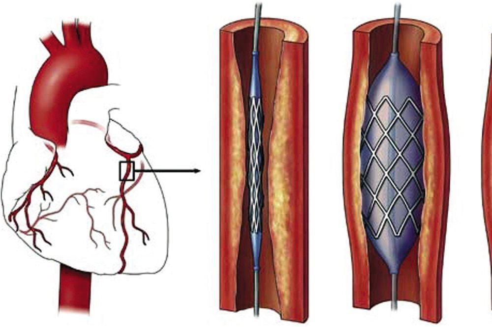 Đặt Stent Trong Bệnh Tim Mạch Là Gì? Quy Trình, Lợi Ích, Rủi Ro Và Lưu Ý Sau Can Thiệp