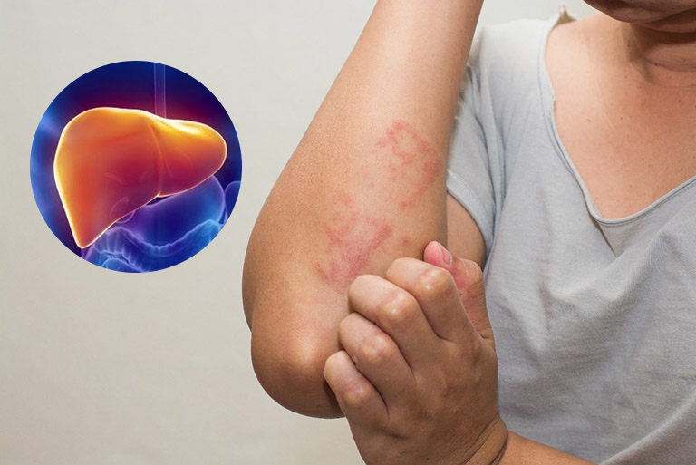 TỔNG QUAN BỆNH LÝ GAN – MẬT: NGUYÊN NHÂN, TRIỆU CHỨNG, ĐIỀU TRỊ VÀ PHÒNG NGỪA