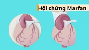 HỘI CHỨNG MARFAN: NGUYÊN NHÂN, TRIỆU CHỨNG, CHẨN ĐOÁN & ĐIỀU TRỊ