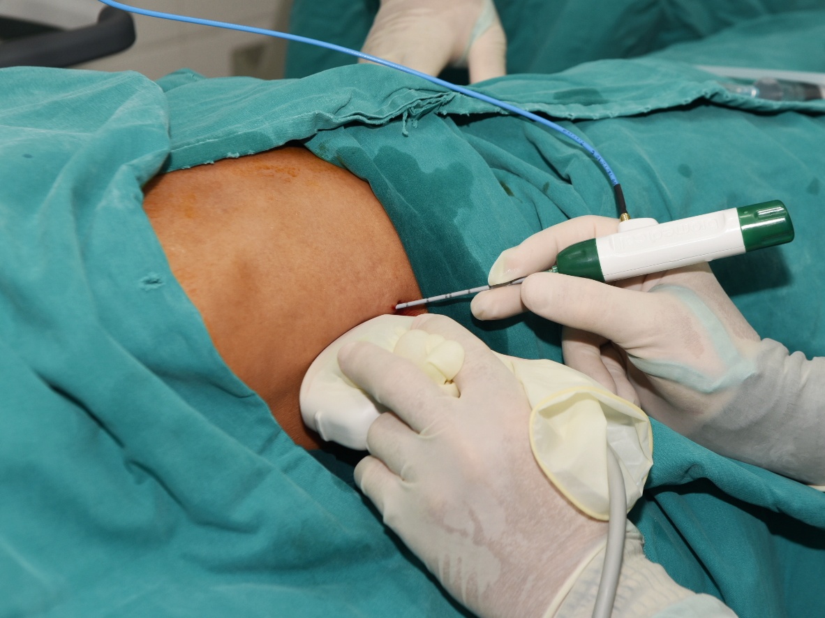 Liệu Pháp Vi Sóng (MWA) Trong Điều Trị Ung Thư: Hiệu Quả, Ứng Dụng và Những Điều Cần Biết