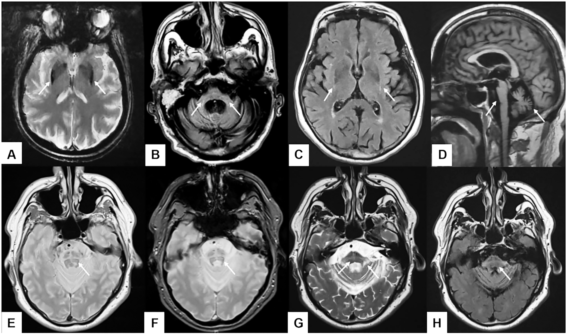 THOÁI HÓA ĐA HỆ THỐNG (MULTIPLE SYSTEM ATROPHY – MSA): BỆNH THẦN KINH HIẾM GẶP, TIẾN TRIỂN NHANH VÀ NGHIÊM TRỌNG
