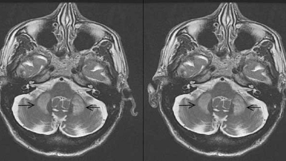 THOÁI HÓA ĐA HỆ THỐNG (MULTIPLE SYSTEM ATROPHY – MSA): BỆNH THẦN KINH HIẾM GẶP, TIẾN TRIỂN NHANH VÀ NGHIÊM TRỌNG