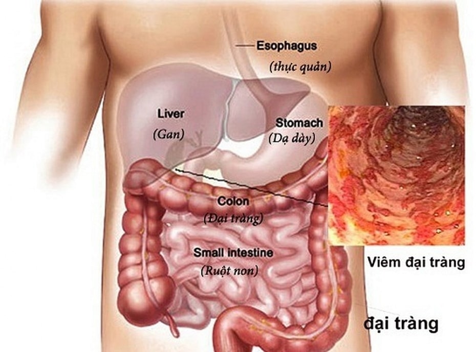 TỔNG QUAN BỆNH LÝ ĐẠI TRÀNG: NGUYÊN NHÂN – TRIỆU CHỨNG – ĐIỀU TRỊ – PHÒNG TRÁNH