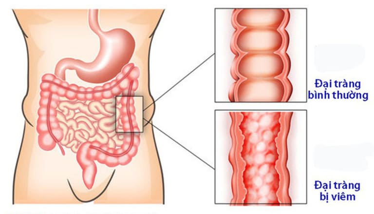 TỔNG QUAN BỆNH LÝ ĐẠI TRÀNG: NGUYÊN NHÂN – TRIỆU CHỨNG – ĐIỀU TRỊ – PHÒNG TRÁNH