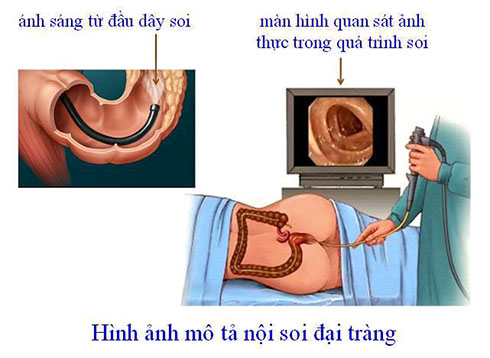 TỔNG QUAN BỆNH LÝ ĐẠI TRÀNG: NGUYÊN NHÂN – TRIỆU CHỨNG – ĐIỀU TRỊ – PHÒNG TRÁNH