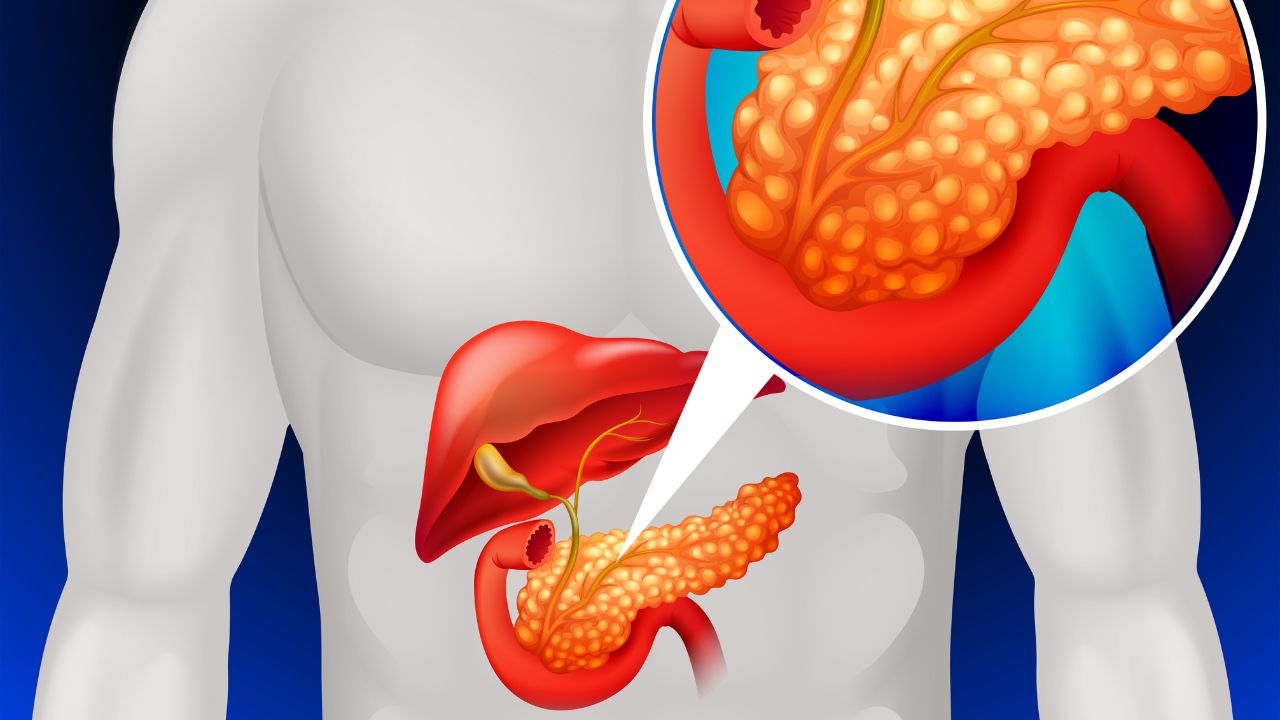 TỔNG QUAN BỆNH LÝ TUYẾN TỤY: TRIỆU CHỨNG, NGUYÊN NHÂN, CHẨN ĐOÁN, ĐIỀU TRỊ VÀ PHÒNG NGỪA