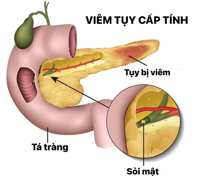 TỔNG QUAN BỆNH LÝ TUYẾN TỤY: TRIỆU CHỨNG, NGUYÊN NHÂN, CHẨN ĐOÁN, ĐIỀU TRỊ VÀ PHÒNG NGỪA
