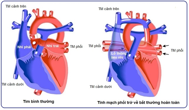 BỆNH TIM BẨM SINH PHỨC TẠP: TỔNG QUAN – CHẨN ĐOÁN – ĐIỀU TRỊ CHUYÊN SÂU