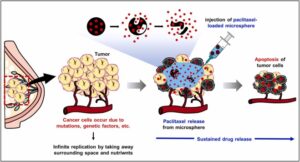 Vi Cầu Tải Thuốc (Drug-Loaded Microspheres) Trong Điều Trị Ung Thư: Bước Tiến Mới Của Can Thiệp Nội Mạch