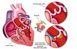 Viêm nội tâm mạc nhiễm khuẩn: Căn bệnh hiếm nhưng cực kỳ nguy hiểm