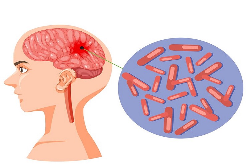 VIÊM NÃO TỰ MIỄN: BỆNH LÝ THẦN KINH NGUY HIỂM CÓ THỂ ĐIỀU TRỊ NẾU PHÁT HIỆN SỚM