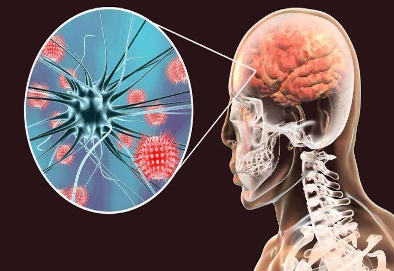 VIÊM NÃO TỰ MIỄN: BỆNH LÝ THẦN KINH NGUY HIỂM CÓ THỂ ĐIỀU TRỊ NẾU PHÁT HIỆN SỚM