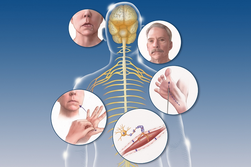 XƠ CỨNG CỘT BÊN TEO CƠ (ALS): BỆNH THOÁI HÓA THẦN KINH NGHIÊM TRỌNG CẦN ĐƯỢC PHÁT HIỆN SỚM