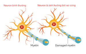 XƠ CỨNG RẢI RÁC (MULTIPLE SCLEROSIS – MS): BỆNH TỰ MIỄN THẦN KINH NGUY HIỂM CẦN NHẬN BIẾT SỚM